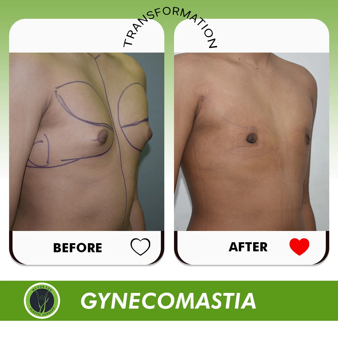 Gynecomastia