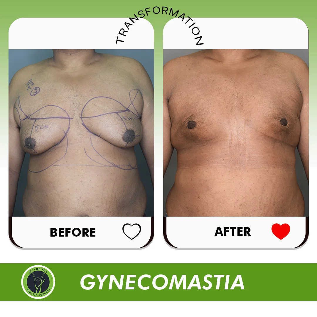 Gynecomastia