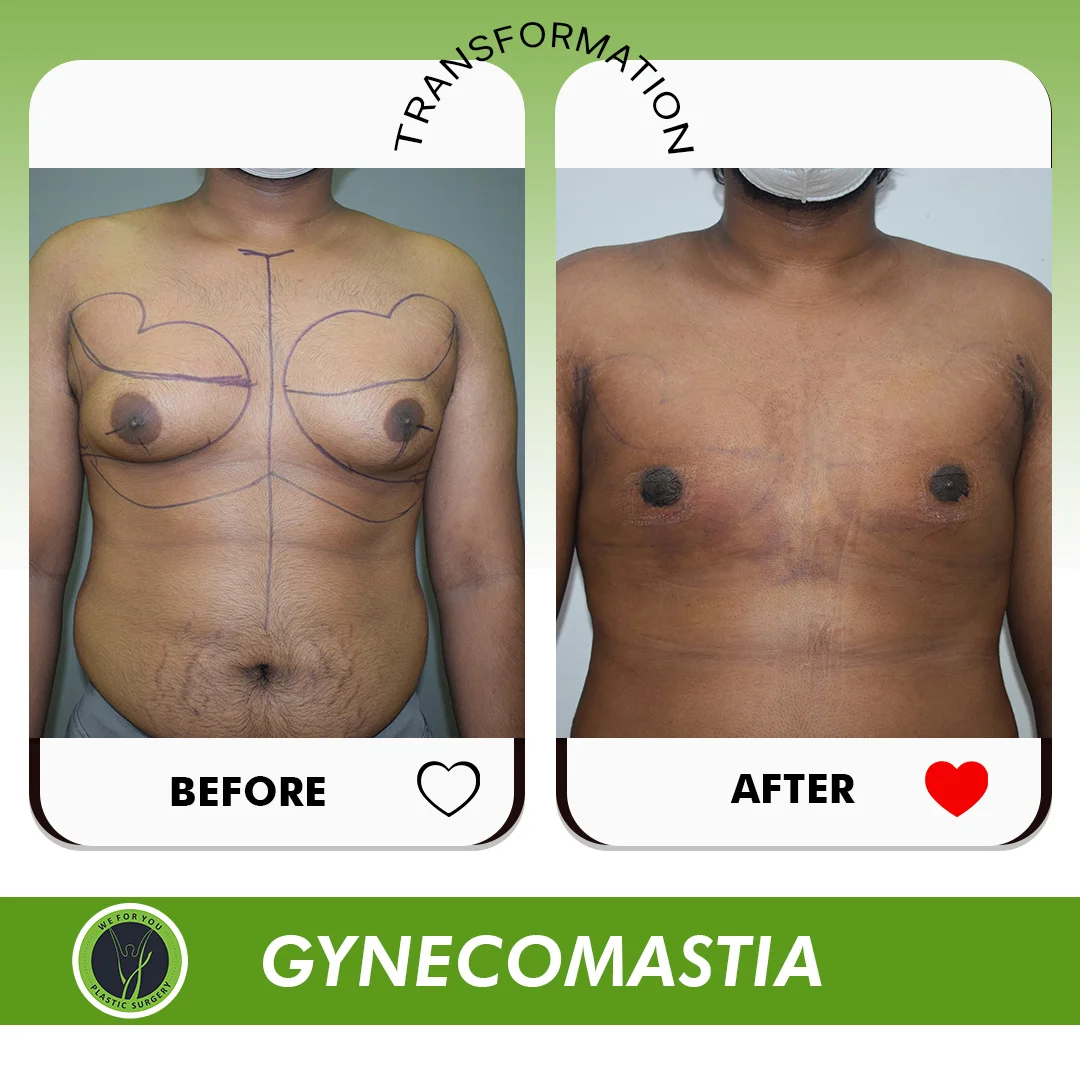 Gynecomastia