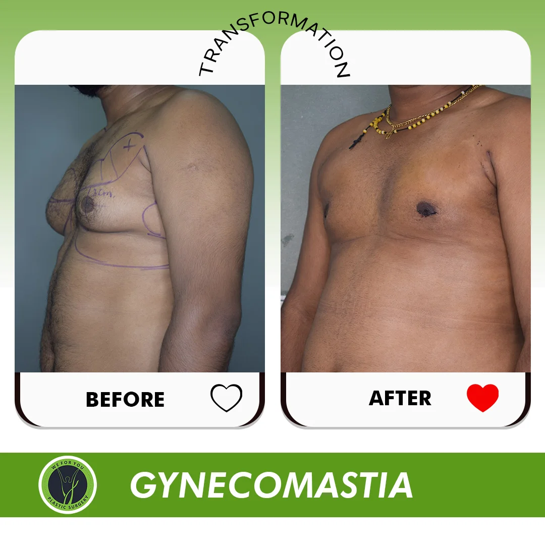 Gynecomastia before and after