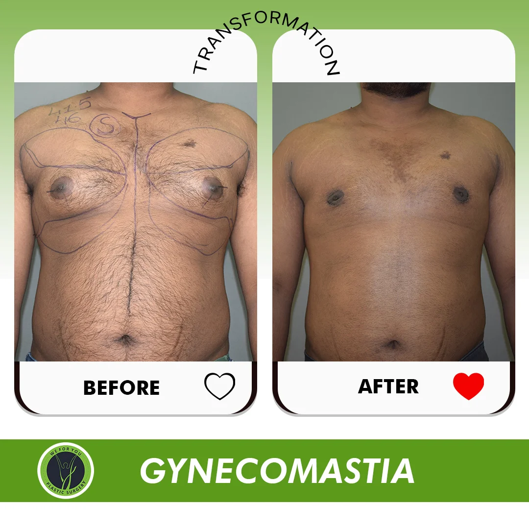 Gynecomastia Before & After