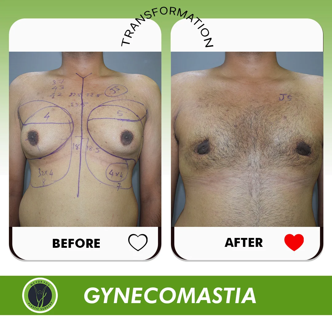 Gynecomastia B&A