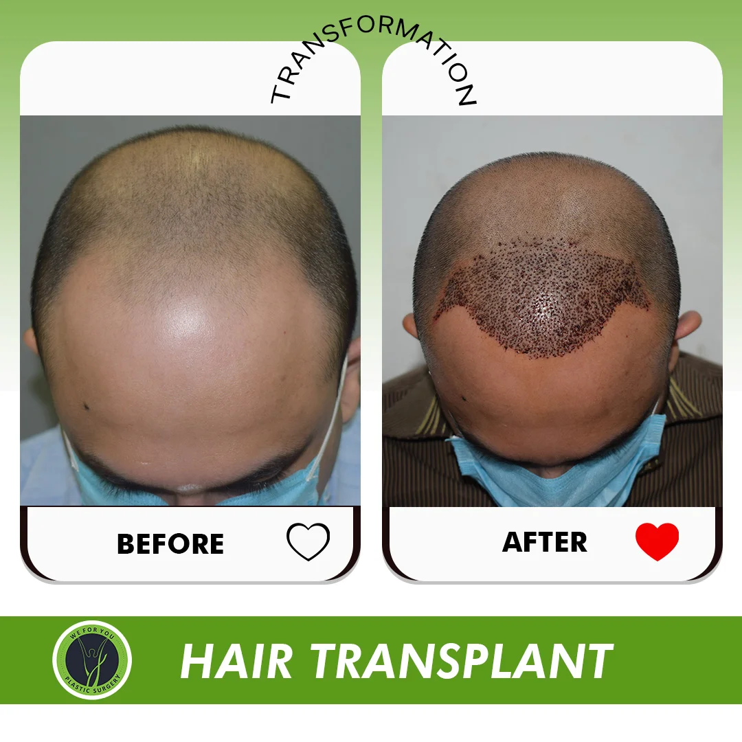 Hair Transplant Before and after 