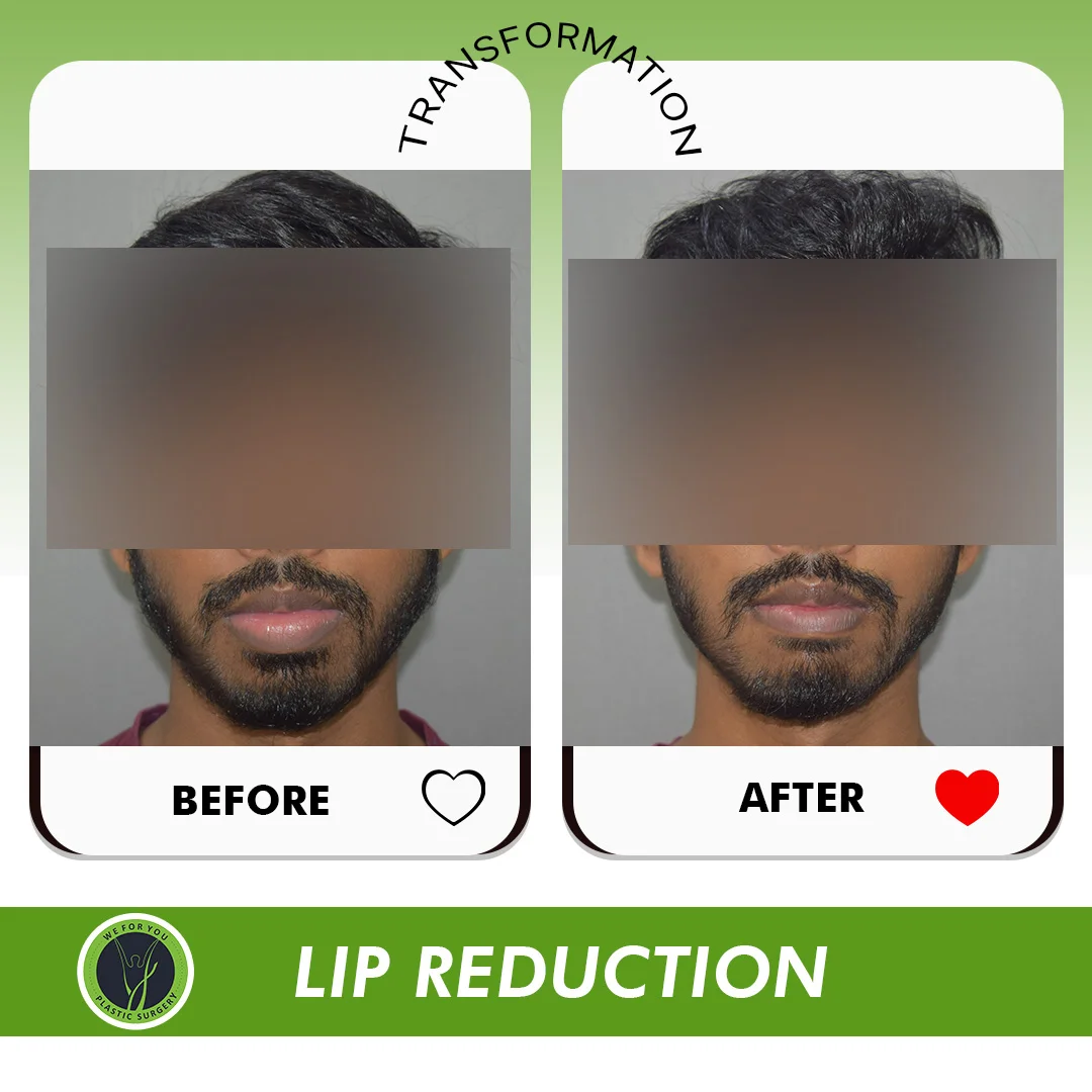lip reduction Before and after