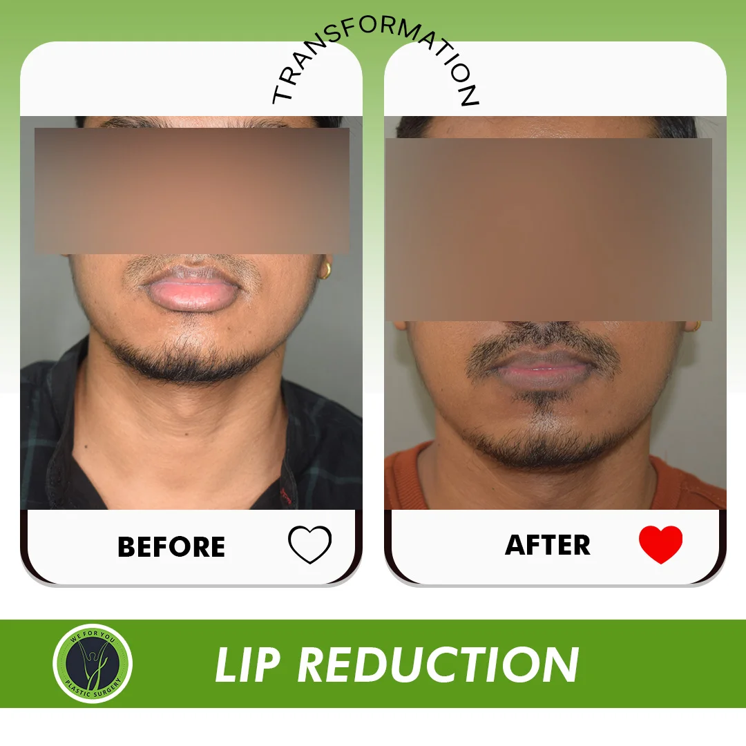 Lip Reduction before and after