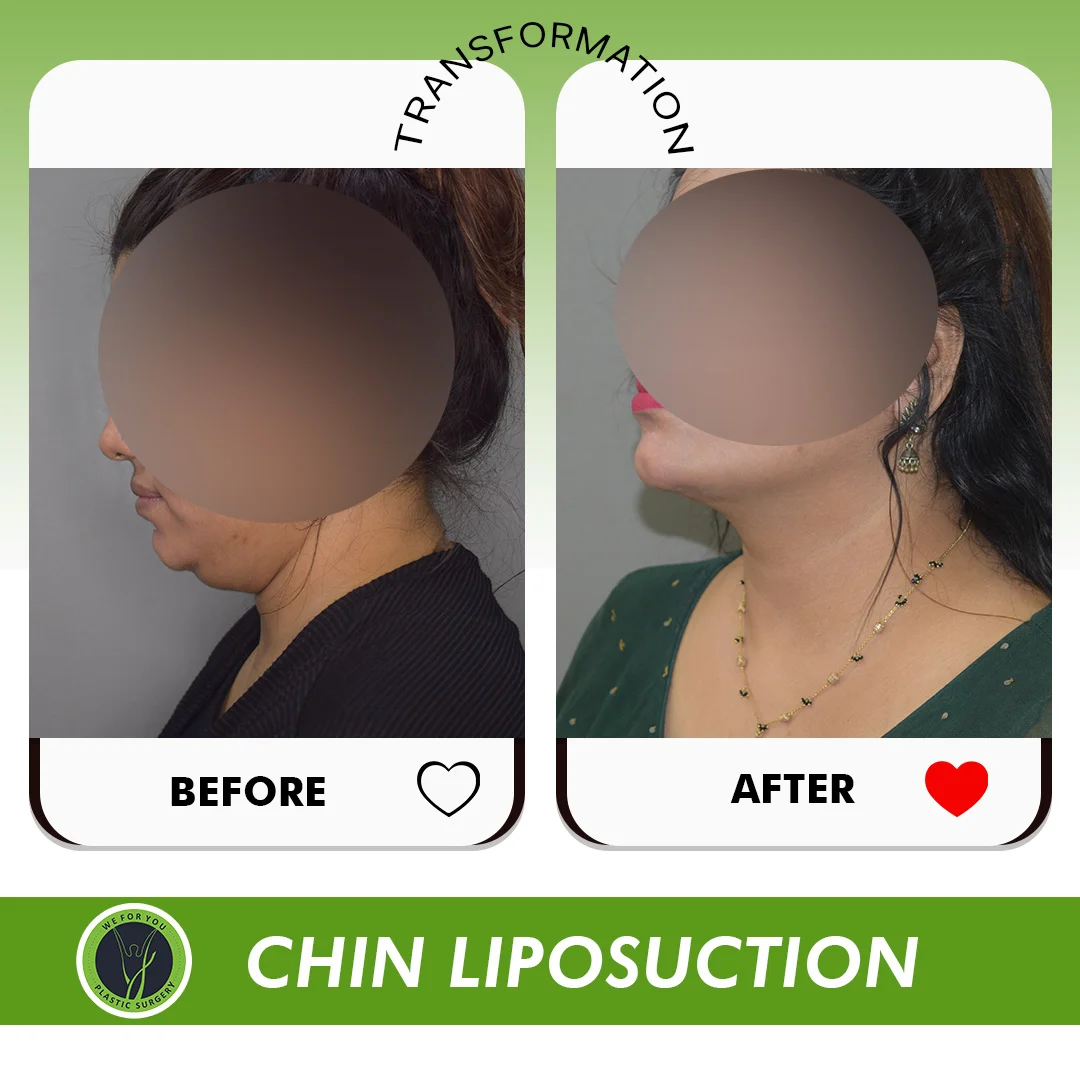 chin liposuction before and after