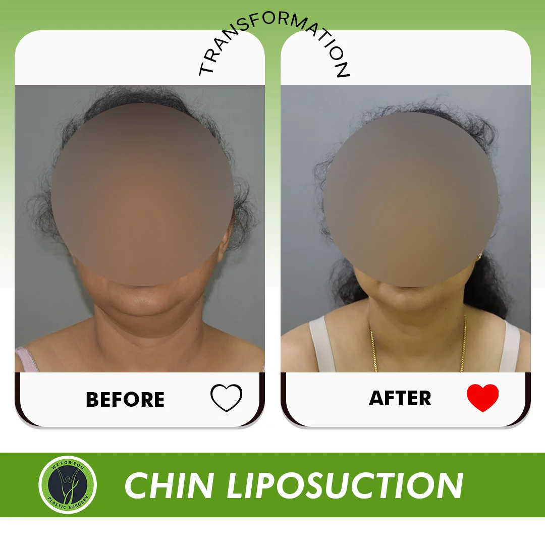 Double Chin Surgery Before and After
