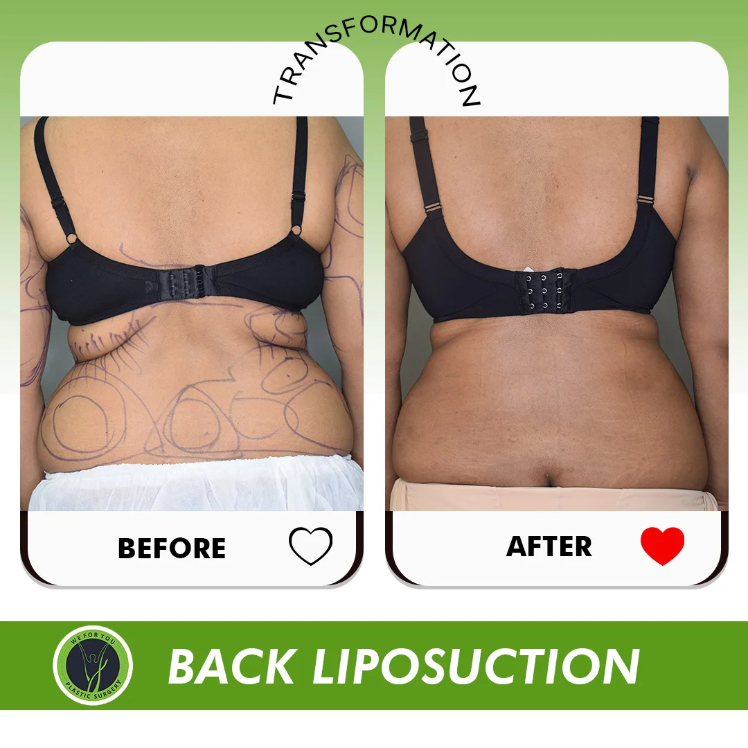 Back Liposuctiopn