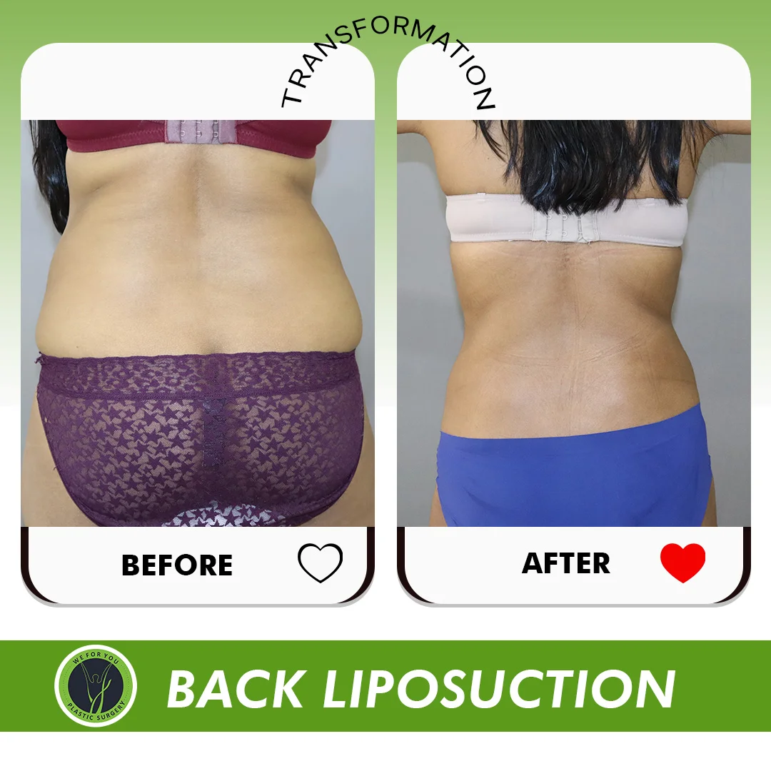 Liposuction