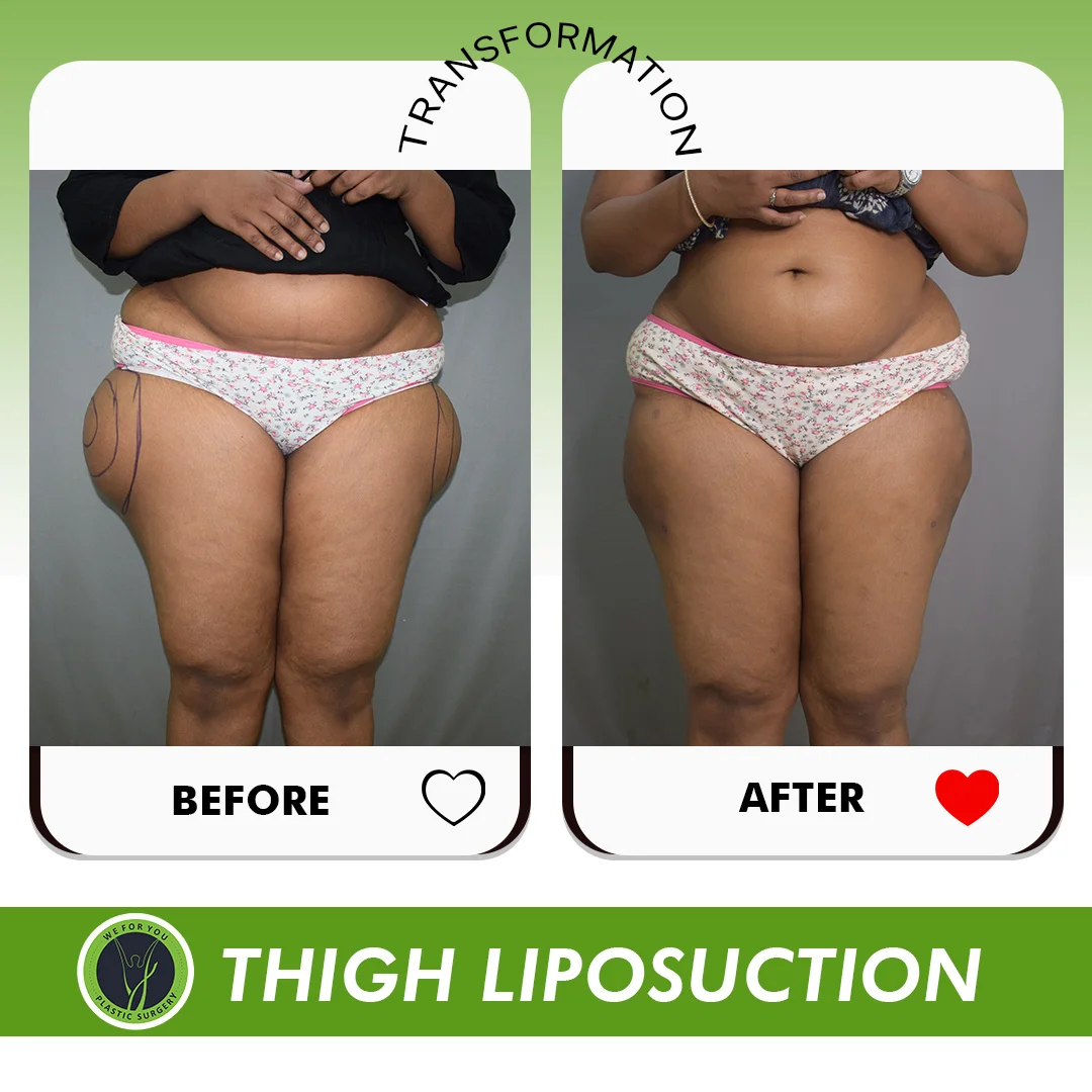 Thigh liposuction before and after