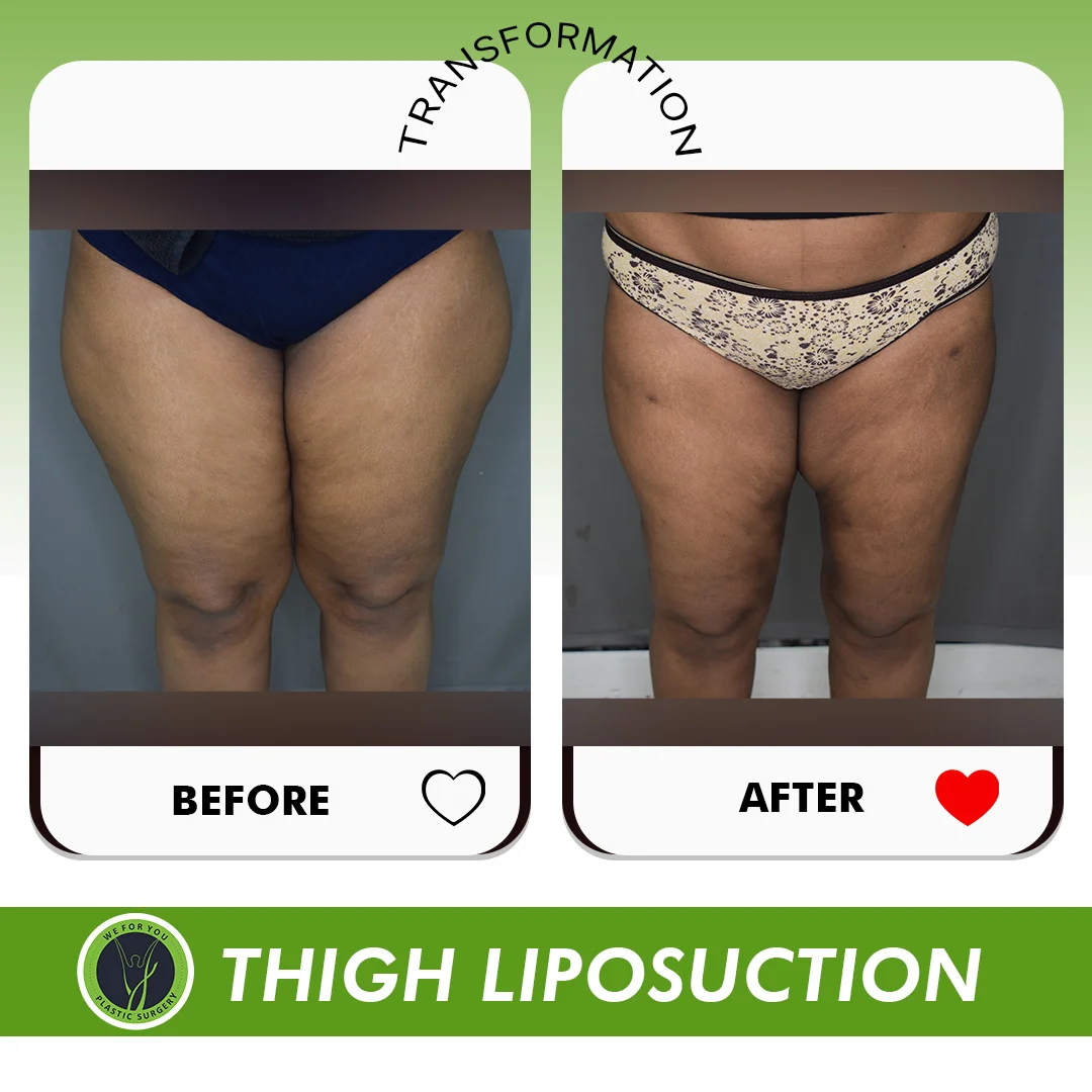 Thigh liposuction before and after 