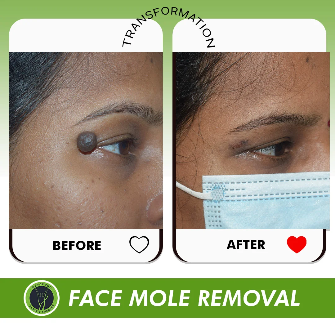 Female Mole Removal