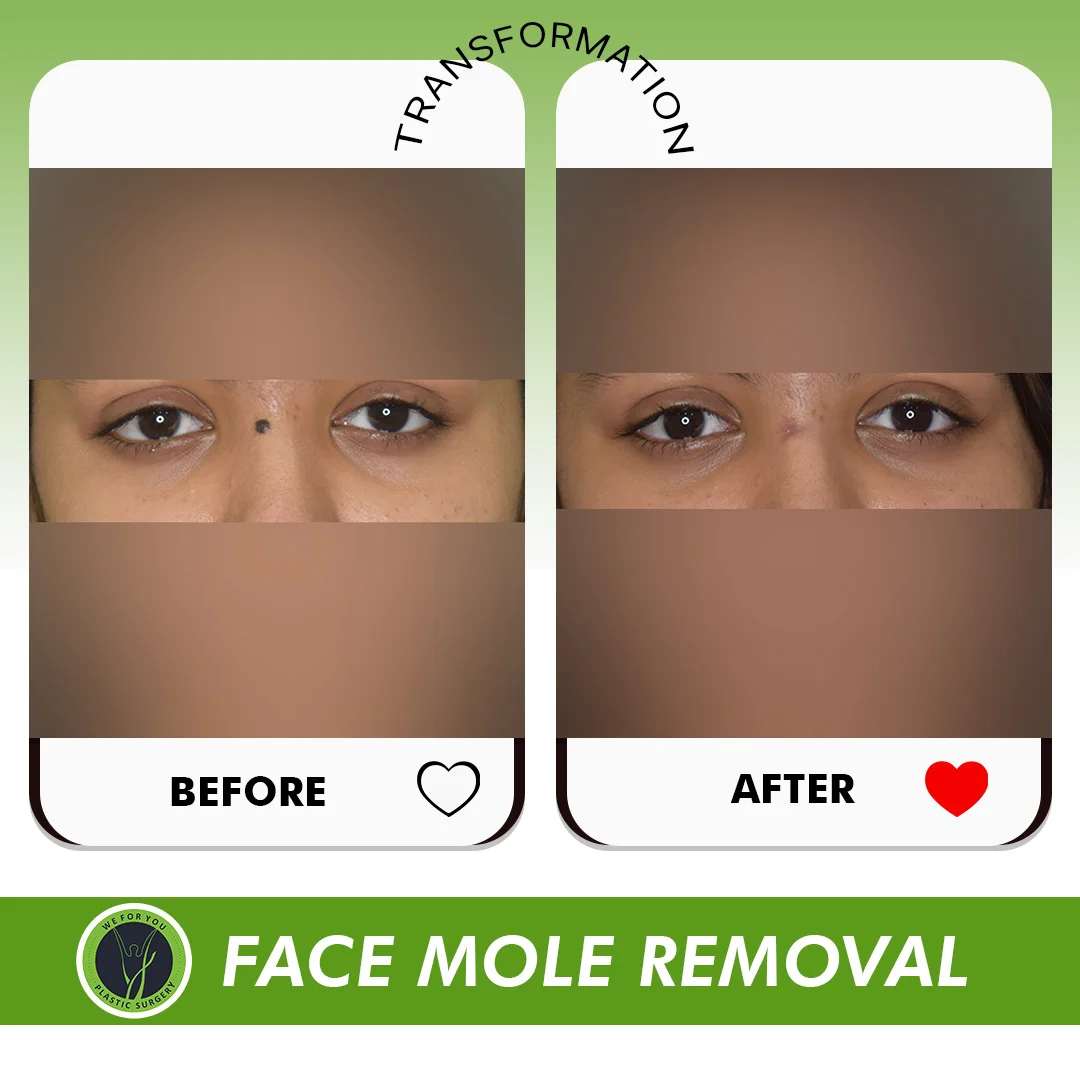 Face Removal Before and After
