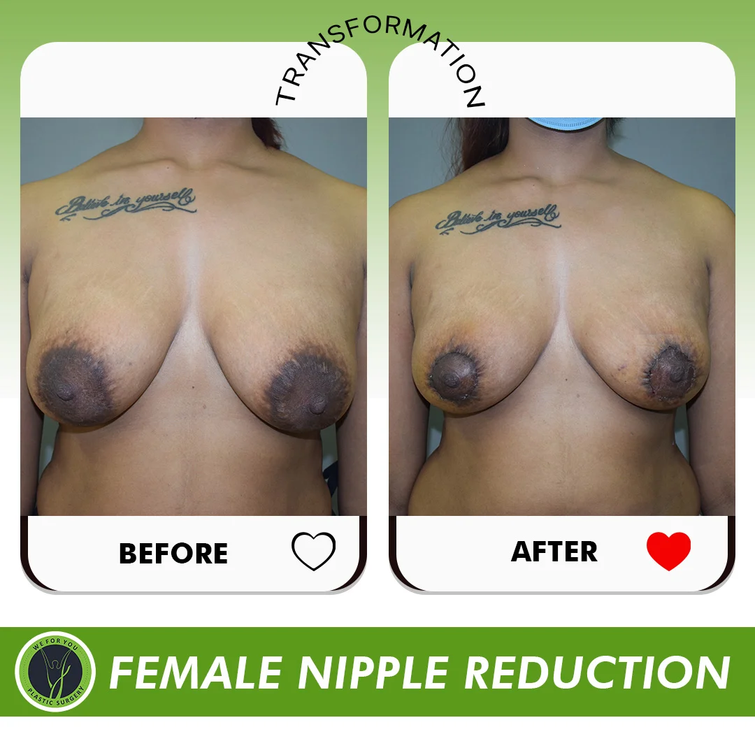 Nipple Correction 