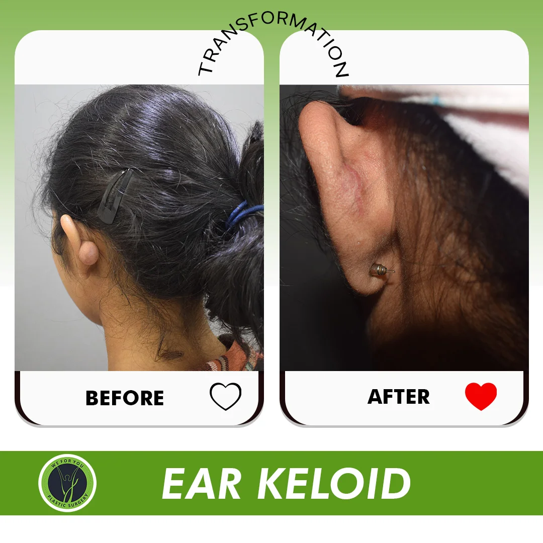 Ear Keloid 
