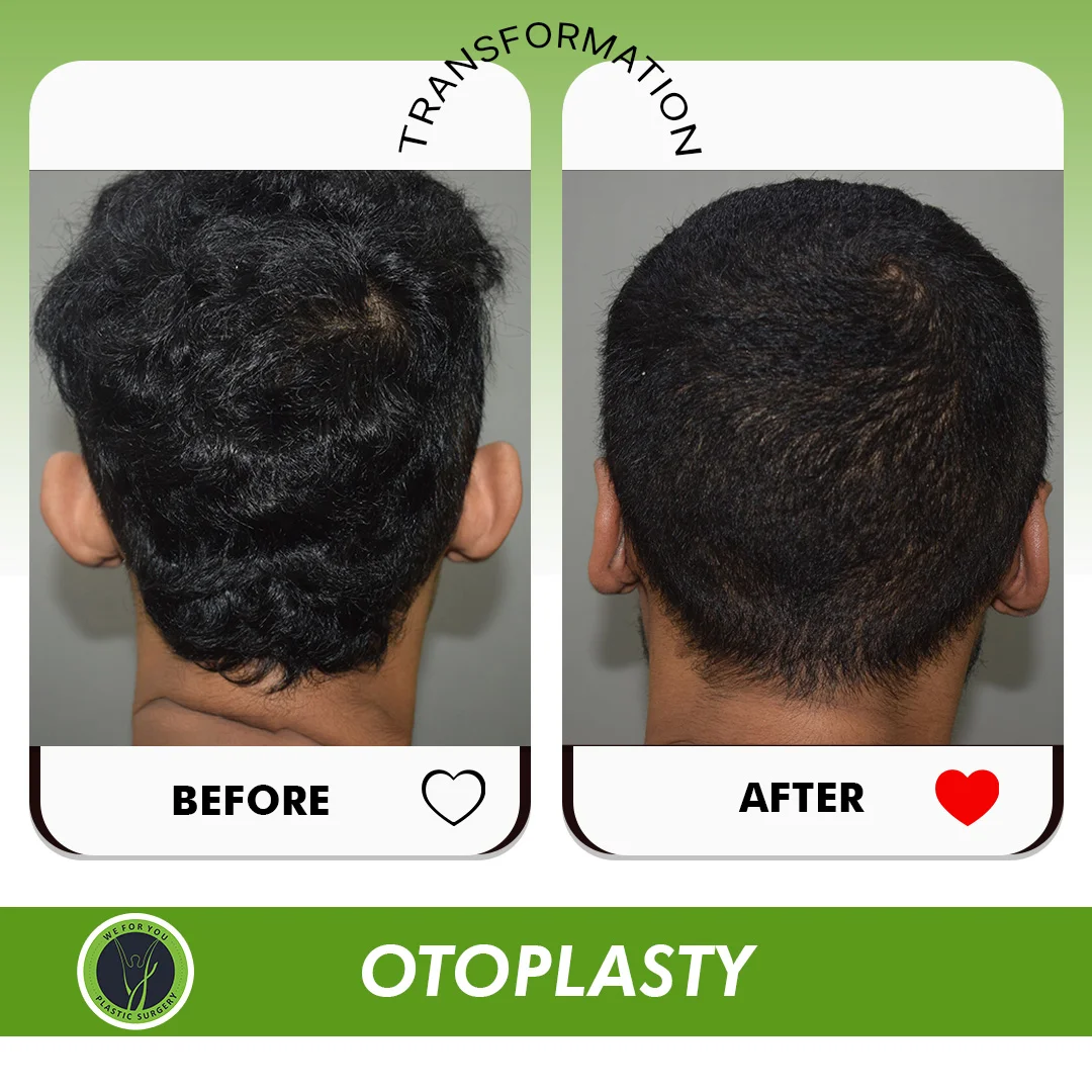  Otoplasty Ear Reshaping