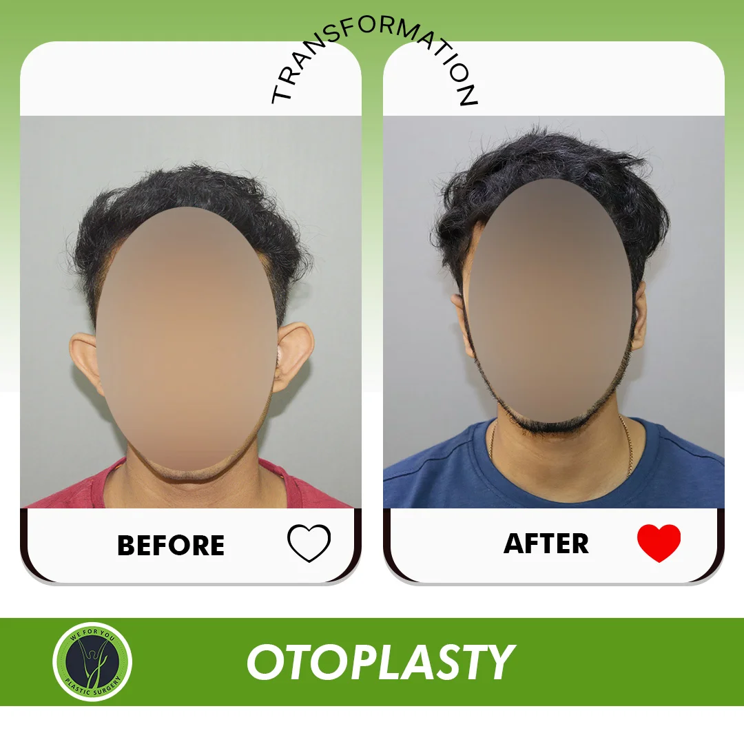 Ear Otoplasty