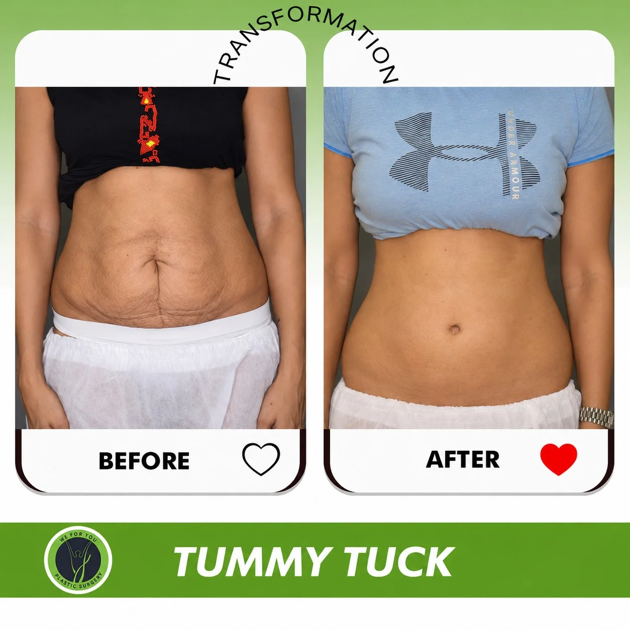 tummy tuck before and after 