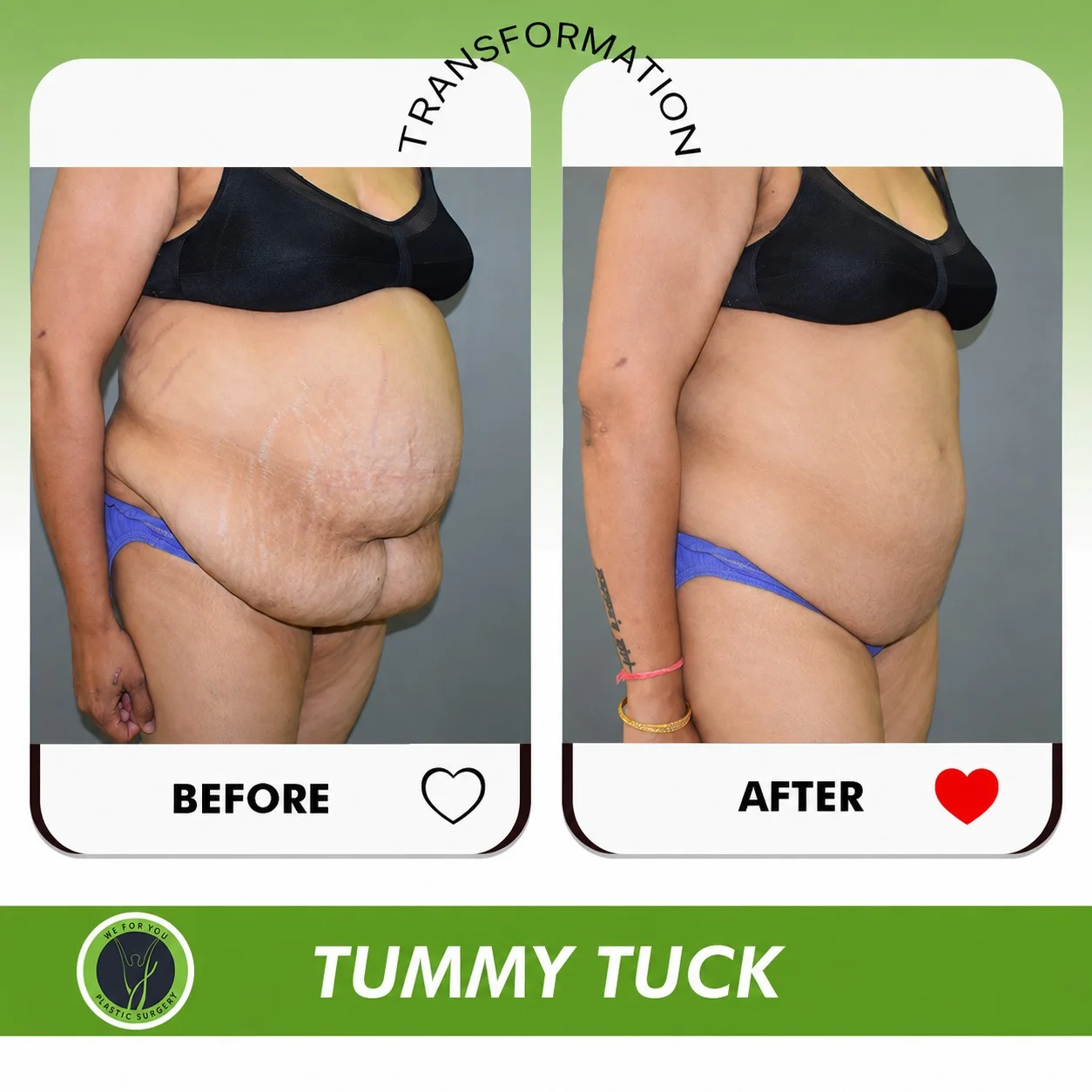 Tummy tuck Before and after