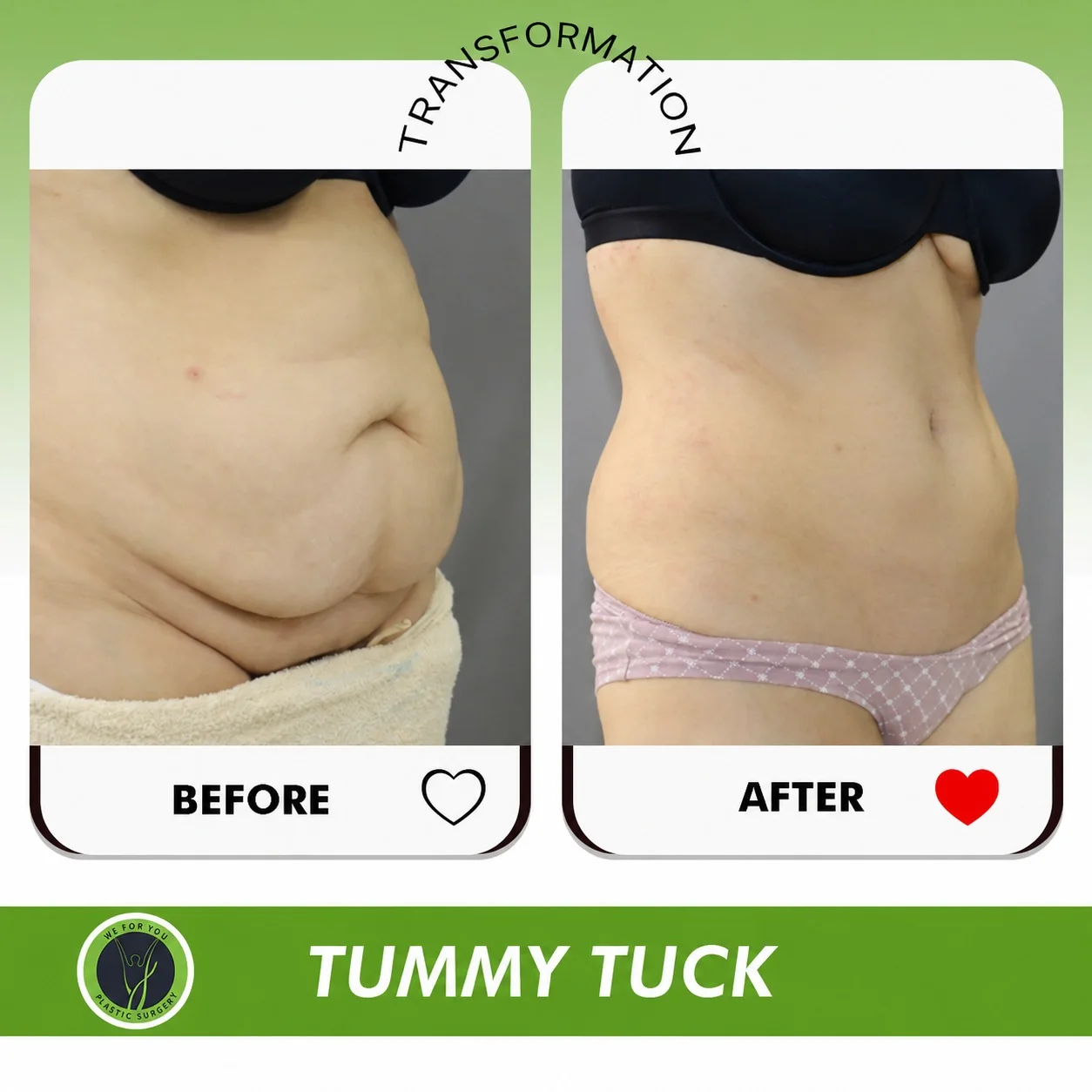 Tummy tuck Before and after