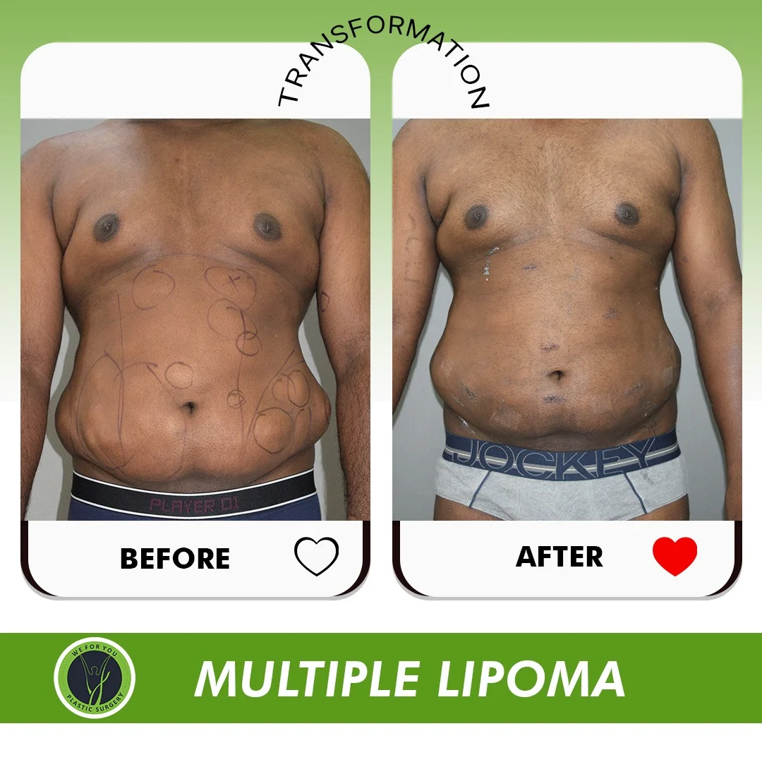 Multiple Lipoma