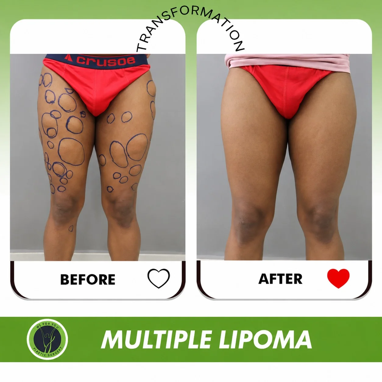 Multiple Lipoma