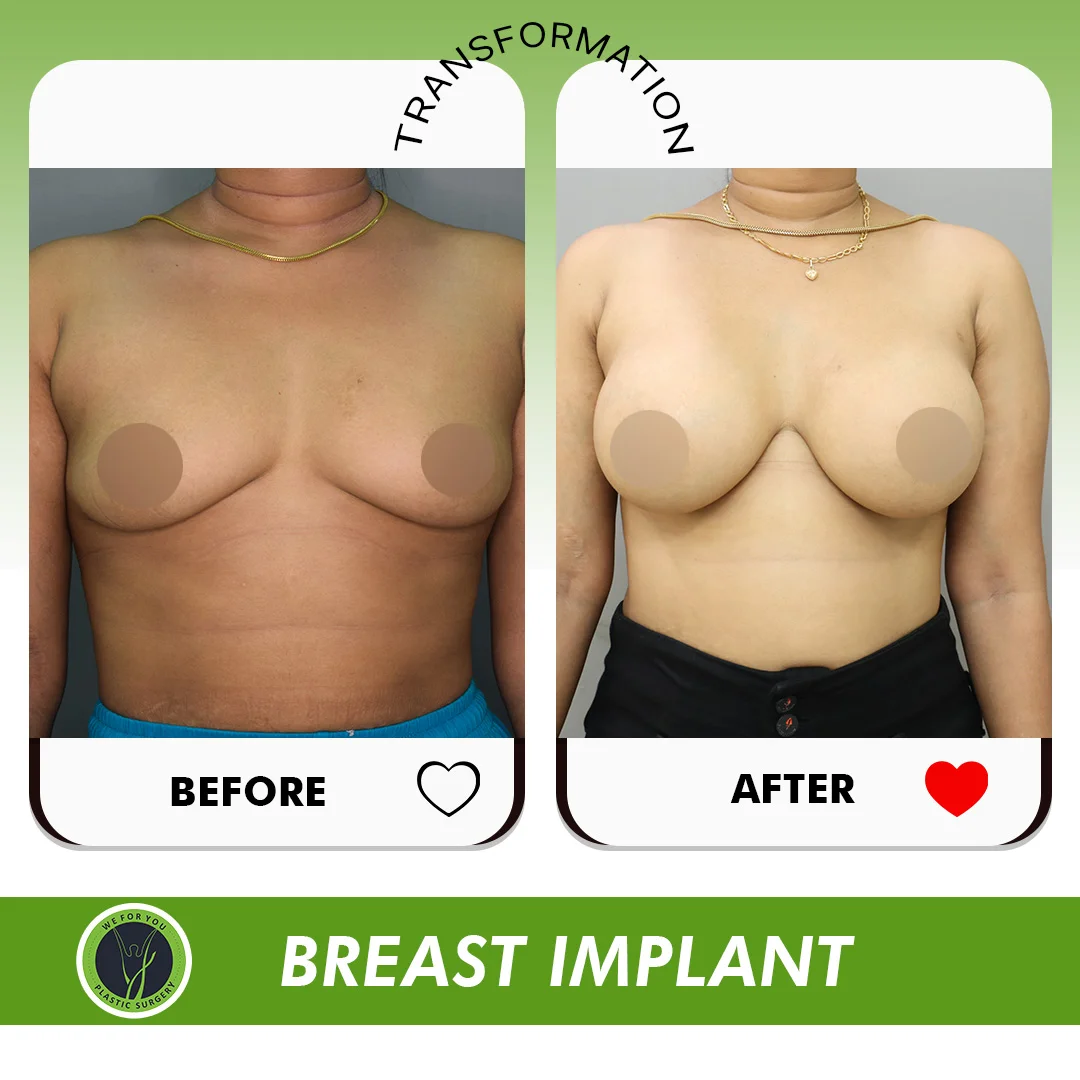 breast implant Before and after