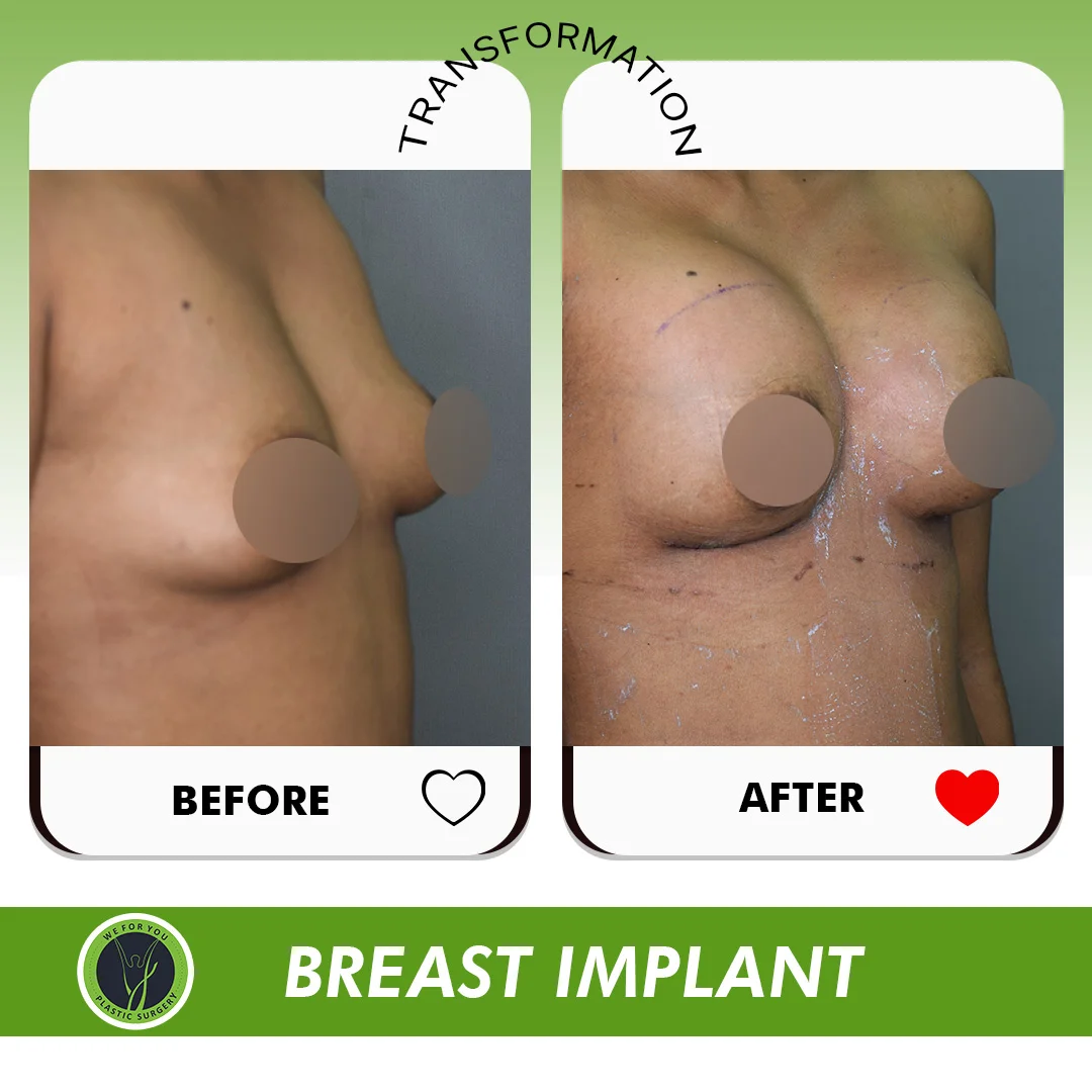 BREAST IMPLANT