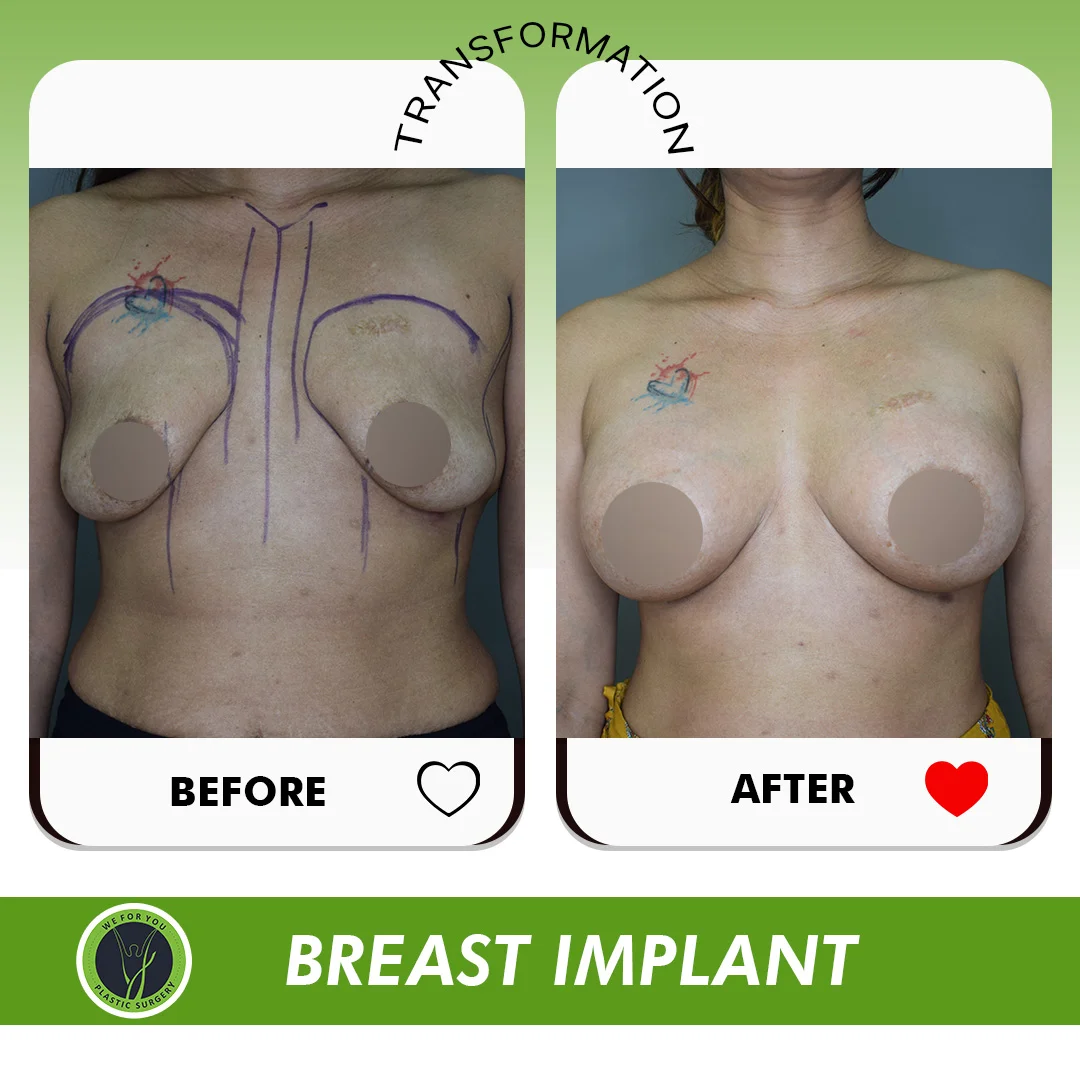Breast Fat Transfer Before and After