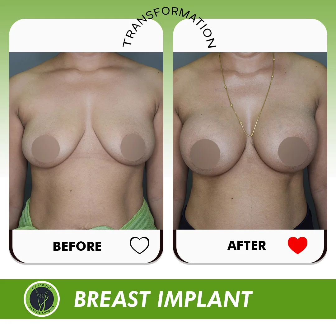 Breast Fat Transfer