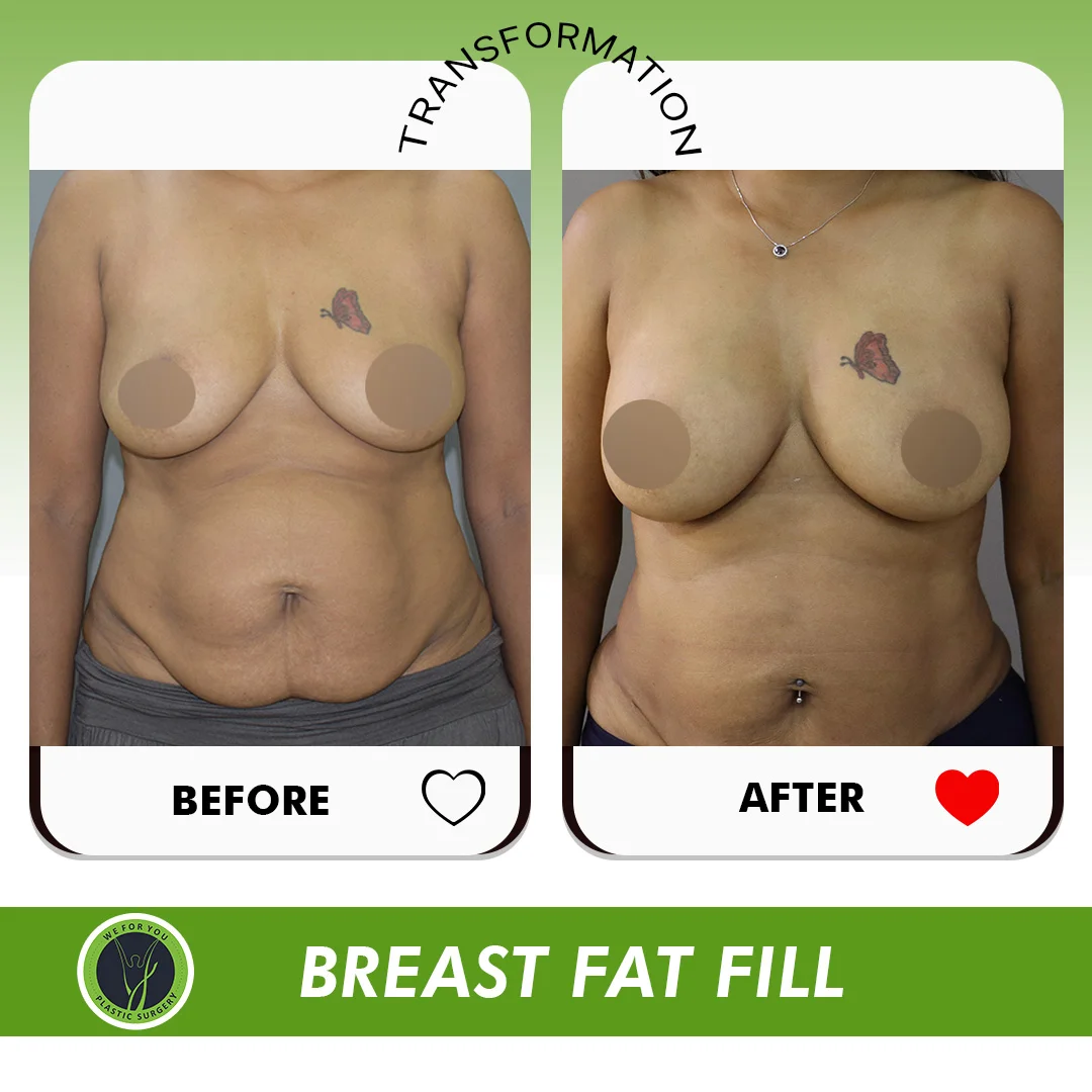 Breast Fat Fill