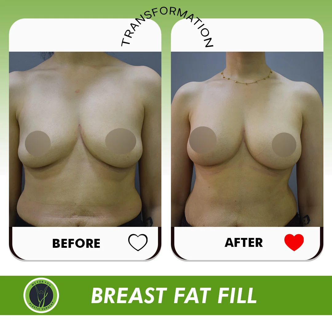 Breast Implant