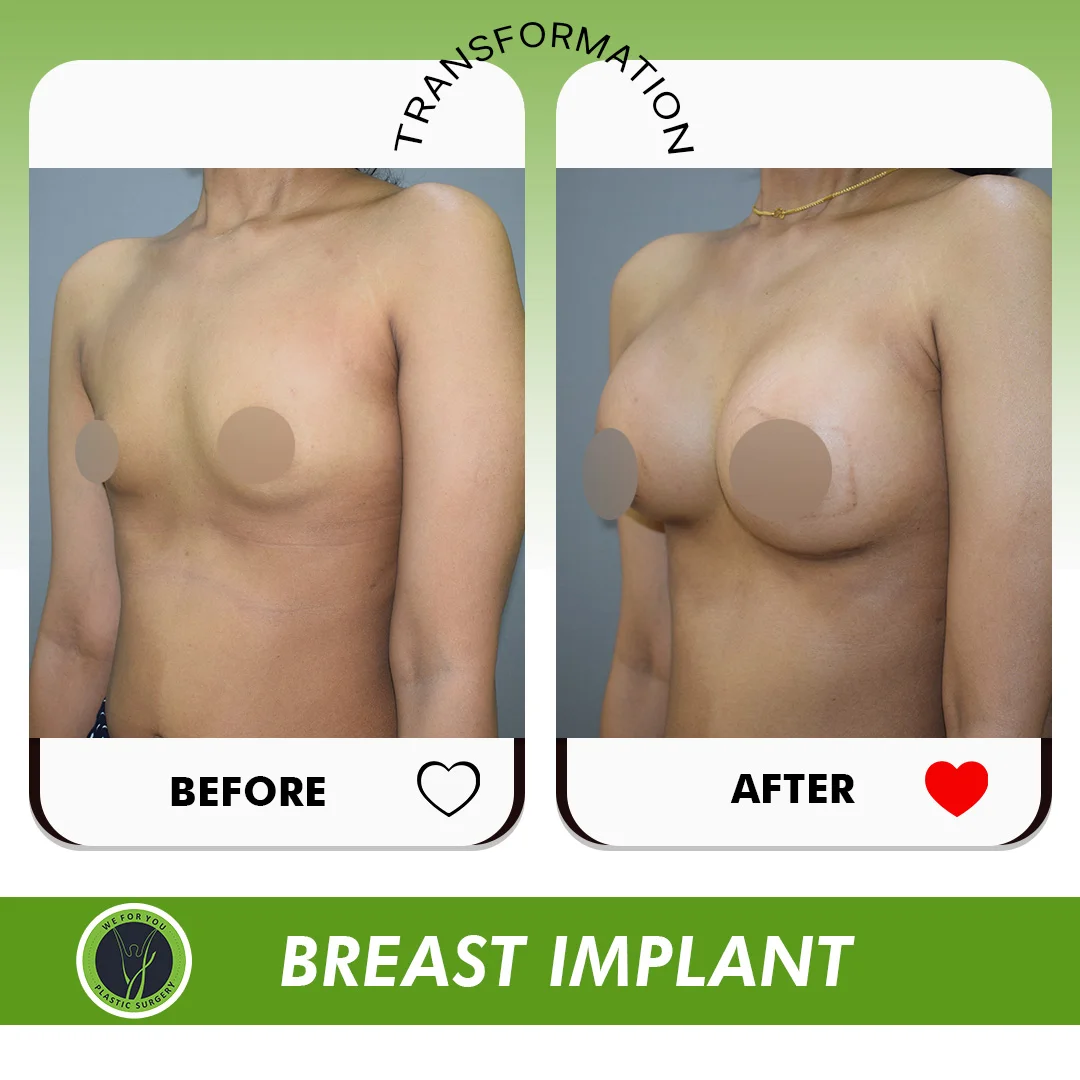 Breast Implant
